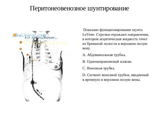 Перитонеовенозное шунтирование Показано функционирование шунта LeVeen. Стрелки отражают направление, в котором асцитическая жидкость течет из брюшной полости в верхнюю полую вену. A. Абдоминальная трубка. B. Однонаправленный клапан. C. Венозная труб…