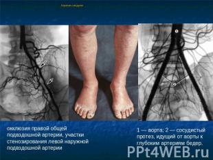 Лериша синдром окклюзия правой общей подвздошной артерии, участки стенозирования