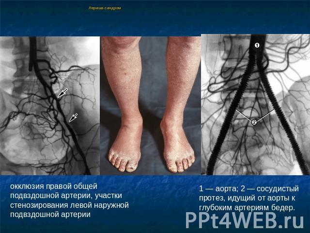 Лериша синдром окклюзия правой общей подвздошной артерии, участки стенозирования левой наружной подвздошной артерии 1 — аорта; 2 — сосудистый протез, идущий от аорты к глубоким артериям бедер.