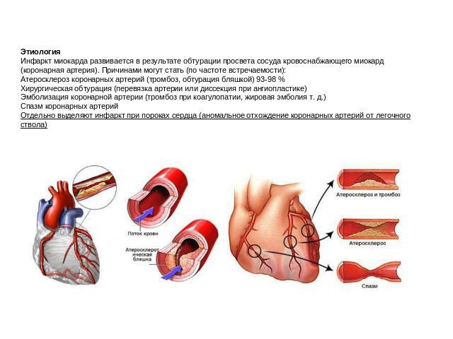 ЭтиологияИнфаркт миокарда развивается в результате обтурации просвета сосуда кровоснабжающего миокард (коронарная артерия). Причинами могут стать (по частоте встречаемости):Атеросклероз коронарных артерий (тромбоз, обтурация бляшкой) 93-98 %Хирургич…