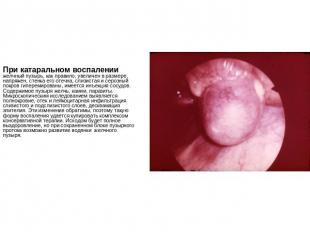 При катаральном воспалении желчный пузырь, как правило, увеличен в размере, напр