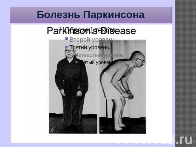 Болезнь Паркинсона