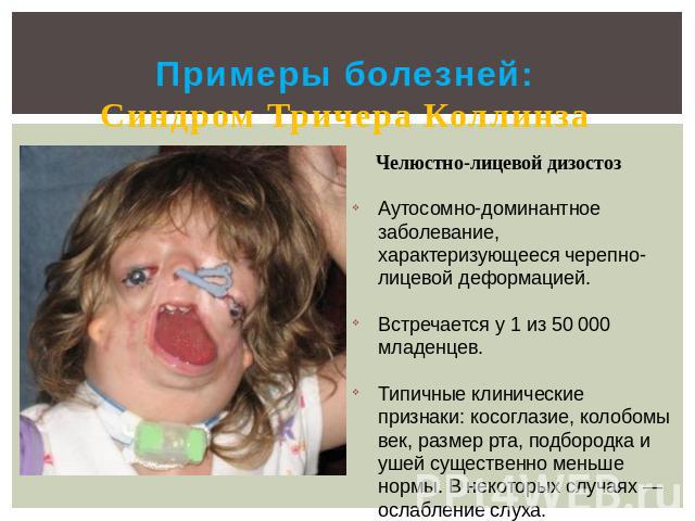 Примеры болезней:Синдром Тричера Коллинза Челюстно-лицевой дизостоз Аутосомно-доминантное заболевание, характеризующееся черепно-лицевой деформацией. Встречается у 1 из 50 000 младенцев. Типичные клинические признаки: косоглазие, колобомы век, разме…