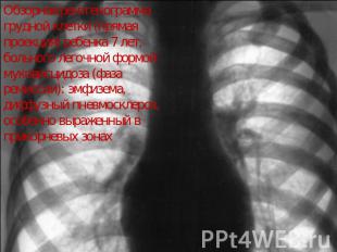 Обзорная рентгенограмма грудной клетки (прямая проекция) ребенка 7 лет, больного