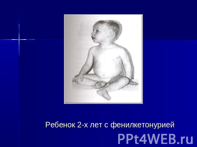 Ребенок 2-х лет с фенилкетонурией