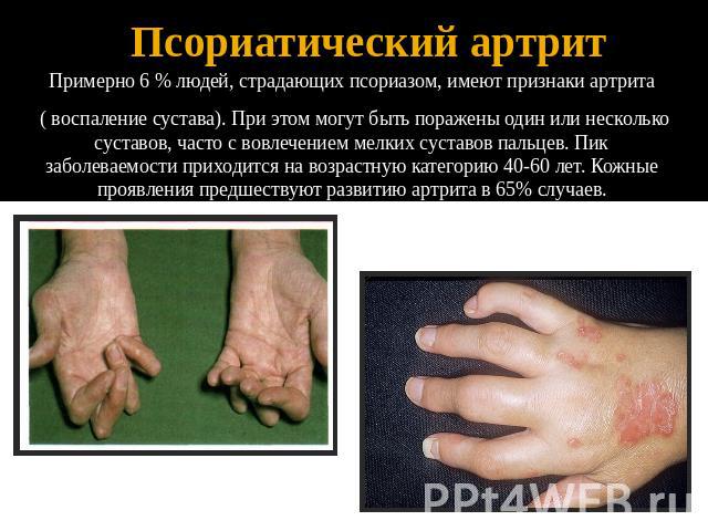 Псориатический артрит Примерно 6 % людей, страдающих псориазом, имеют признаки артрита ( воспаление сустава). При этом могут быть поражены один или несколько суставов, часто с вовлечением мелких суставов пальцев. Пик заболеваемости приходится на воз…
