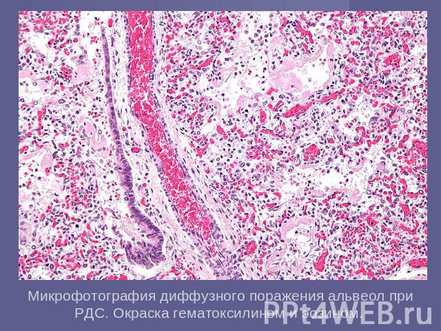 Микрофотография диффузного поражения альвеол при РДС. Окраска гематоксилином и эозином.