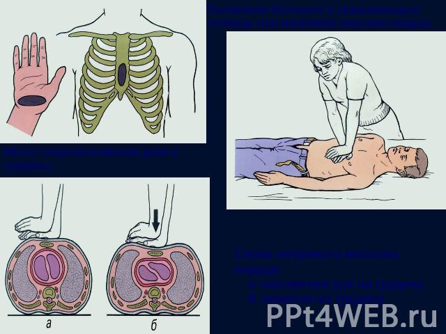 Положение больного и оказывающего  помощь при непрямом массаже сердца. Место соприкосновения руки и грудины             Схема непрямого массажа сердца:     а -наложение рук на грудину    б -нажатие на грудину