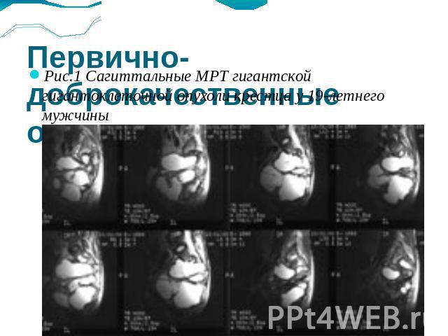 Первично-доброкачественные опухоли позвоночника Рис.1 Сагиттальные МРТ гигантской гигантоклеточной опухоли крестца у 19-летнего мужчины