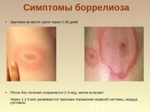 Симптомы боррелиоза Эритема на месте укуса через 2-30 дней Пятно без лечения сох