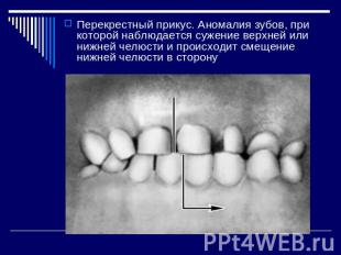 Перекрестный прикус. Аномалия зубов, при которой наблюдается сужение верхней или