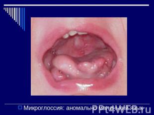Микроглоссия: аномально маленький язык