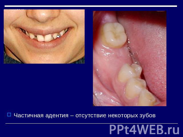 астичная адентия – отсутствие некоторых зубов