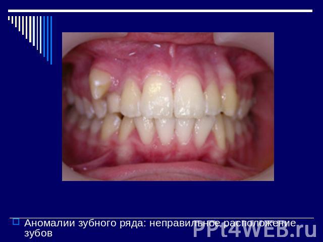 Аномалии зубного ряда: неправильное расположение зубов