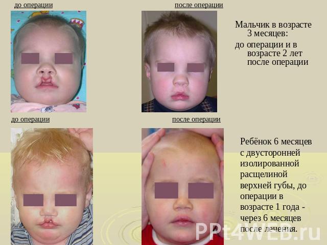 до операции после операции до операции после операции Мальчик в возрасте 3 месяцев:до операции и в возрасте 2 лет после операции Ребёнок 6 месяцев с двусторонней изолированной расщелиной верхней губы, до операции в возрасте 1 года - через 6 месяцев …