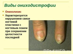 Виды ониходистрофии Онихолизис Характеризуется нарушением связи ногтевой пластин