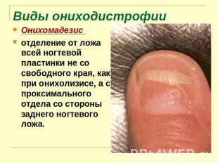Виды ониходистрофии Онихомадезис отделение от ложа всей ногтевой пластинки не со