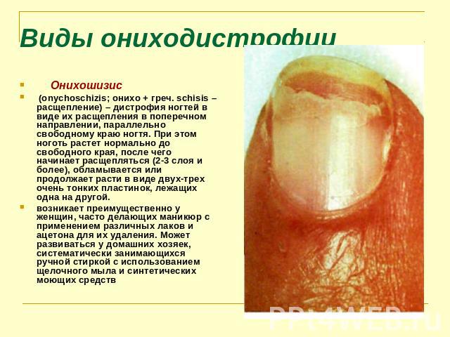 Виды ониходистрофии      Онихошизис (onychoschizis; онихо + греч. schisis – расщепление) – дистрофия ногтей в виде их расщепления в поперечном направлении, параллельно свободному краю ногтя. При этом ноготь растет нормально …