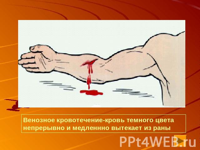 Венозное кровотечение-кровь темного цвета непрерывно и медленнно вытекает из раны
