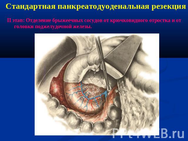 Стандартная панкреатодуоденальная резекцияII этап: Отделение брыжеечных сосудов от крючковидного отростка и от головки поджелудочной железы.