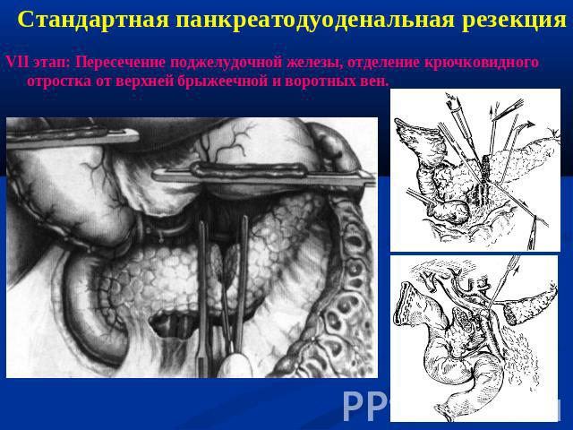 Стандартная панкреатодуоденальная резекцияVII этап: Пересечение поджелудочной железы, отделение крючковидного отростка от верхней брыжеечной и воротных вен.