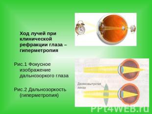 Ход лучей при клинической рефракции глаза – гиперметропия Рис.1 Фокусное изображ