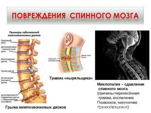 Повреждения спинного мозга Грыжа межпозвонковых дисков Травма «ныряльщика» Миело