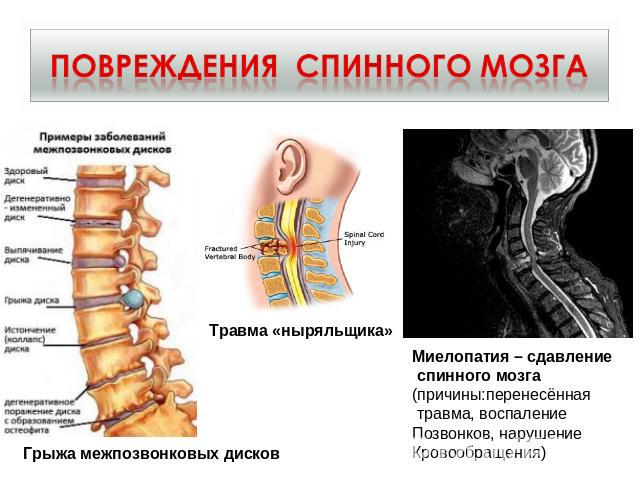 Повреждения спинного мозга Грыжа межпозвонковых дисков Травма «ныряльщика» Миелопатия – сдавление спинного мозга (причины:перенесённая травма, воспаление Позвонков, нарушение Кровообращения)