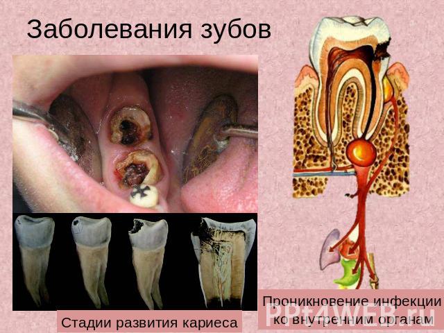 Заболевания зубов Стадии развития кариеса Проникновение инфекции ко внутренним органам