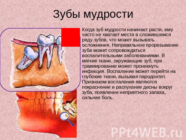 Зубы мудрости Когда зуб мудрости начинает расти, ему часто не хватает места в сложившемся ряду зубов, что может вызывать осложнения. Неправильное прорезывание зуба может сопровождаться воспалительными заболеваниями. В мягкие ткани, окружающие зуб, п…