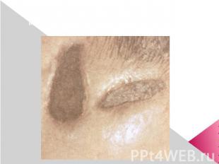 Электроожог IV степени на коже головы: видны два участка сухого некроза (серо-че