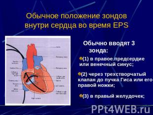 Обычное положение зондов внутри сердца во время EPS Обычно вводят 3 зонда: (1) в