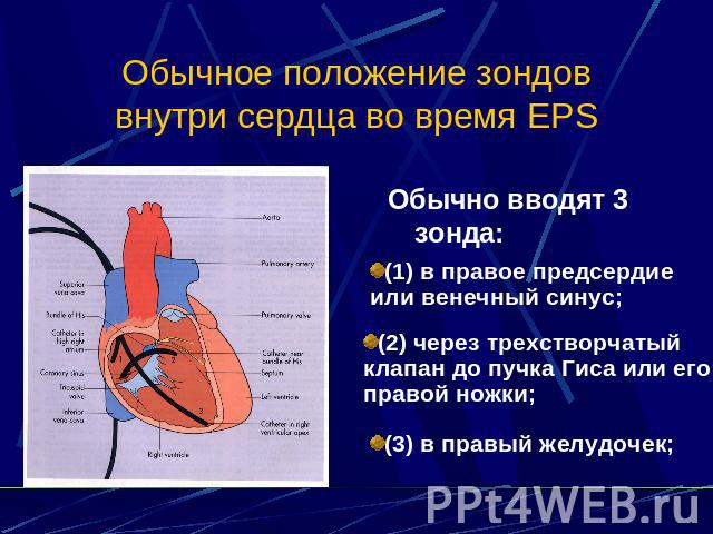 Обычное положение зондов внутри сердца во время EPS Обычно вводят 3 зонда: (1) в правое предсердие или венечный синус; (2) через трехстворчатый клапан до пучка Гиса или его правой ножки; (3) в правый желудочек;