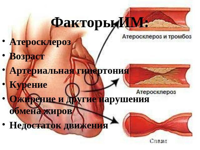Факторы ИМ: Атеросклероз Возраст Артериальная гипертония Курение Ожирение и другие нарушения обмена жиров Недостаток движения