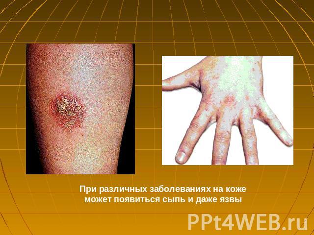 При различных заболеваниях на коже может появиться сыпь и даже язвы