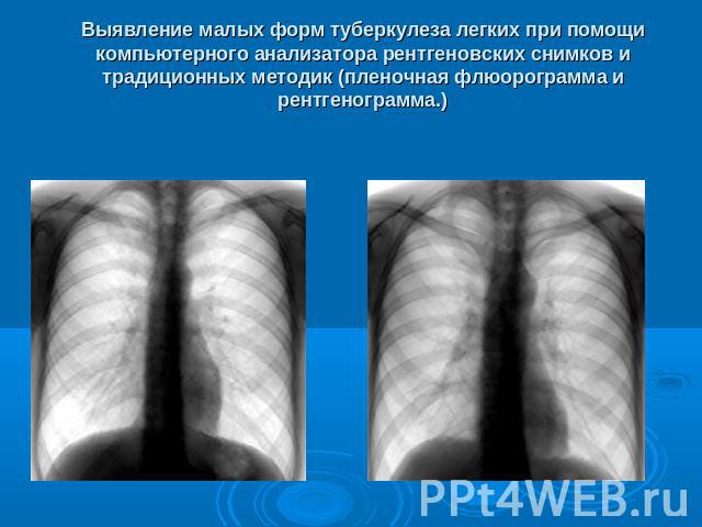 Выявление малых форм туберкулеза легких при помощи компьютерного анализатора рентгеновских снимков и традиционных методик (пленочная флюорограмма и рентгенограмма.)