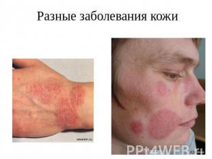 Разные заболевания кожи