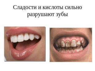 Сладости и кислоты сильно разрушают зубы