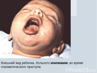 Внешний вид ребенка, больного коклюшем, во время спазматического приступа