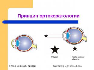 Принцип ортокератологии Глаз с «ночной» линзой Глаз после «ночной» линзы