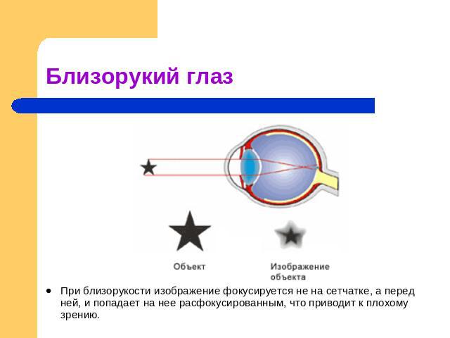 Близорукий глаз При близорукости изображение фокусируется не на сетчатке, а перед ней, и попадает на нее расфокусированным, что приводит к плохому зрению.