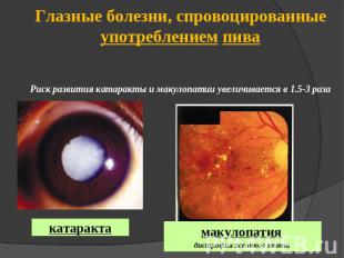 Глазные болезни, спровоцированные употреблением пиваРиск развития катаракты и ма