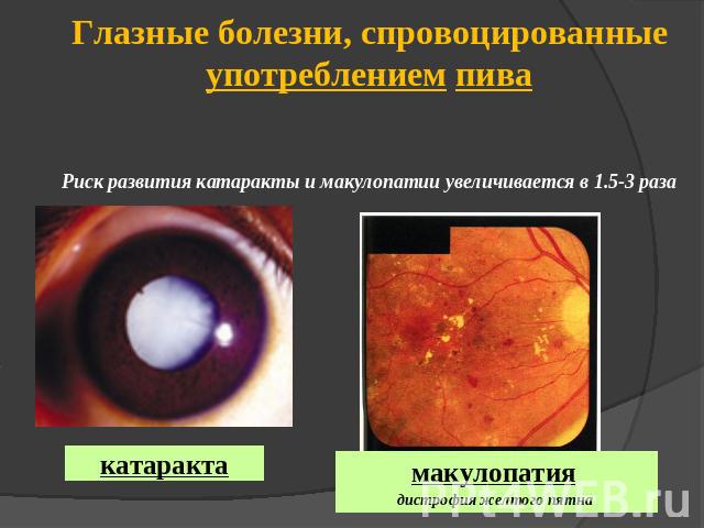 Глазные болезни, спровоцированные употреблением пиваРиск развития катаракты и макулопатии увеличивается в 1.5-3 раза катаракта макулопатия дистрофия желтого пятна