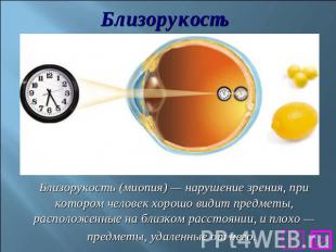 БлизорукостьБлизорукость (миопия)&nbsp;— нарушение зрения, при котором человек х
