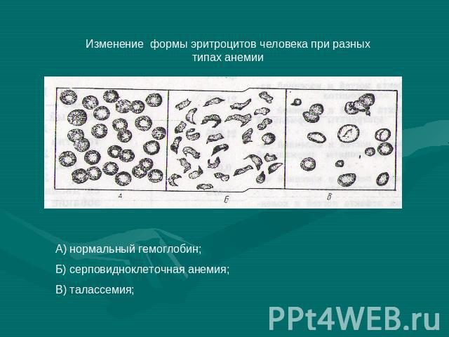 Изменение формы эритроцитов человека при разных типах анемииА) нормальный гемоглобин;Б) серповидноклеточная анемия;В) талассемия;