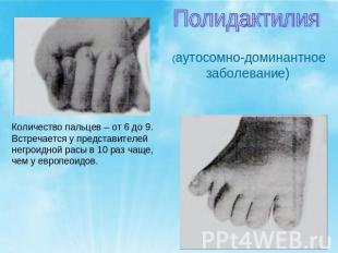 Полидактилия (аутосомно-доминантное заболевание)Количество пальцев – от 6 до 9.В