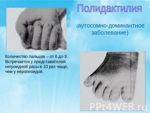 Полидактилия (аутосомно-доминантное заболевание)Количество пальцев – от 6 до 9.Встречается у представителей негроидной расы в 10 раз чаще, чем у европеоидов.
