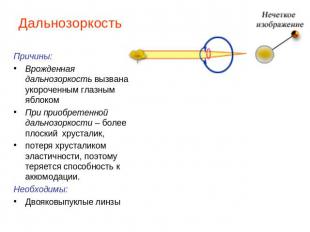 Дальнозоркость Причины:Врожденная дальнозоркость вызвана укороченным глазным ябл