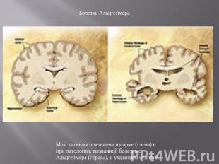 Болезнь Альцгеймера Мозг пожилого человека в норме (слева) и при патологии, вызв