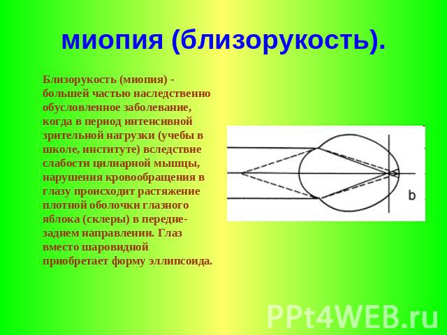 миопия (близорукость). Близорукость (миопия) - большей частью наследственно обусловленное заболевание, когда в период интенсивной зрительной нагрузки (учебы в школе, институте) вследствие слабости цилиарной мышцы, нарушения кровообращения в глазу пр…